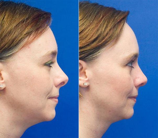 Miglior chirurgo rinoplastica a Milano – plastic surgeon rhinoplasty